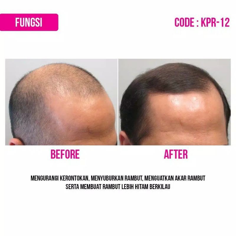 Hair Tonic Penumbuh Dan Pencegah Rambut Rontok / Penghitam rambut Uban Alami Orginal BPOM