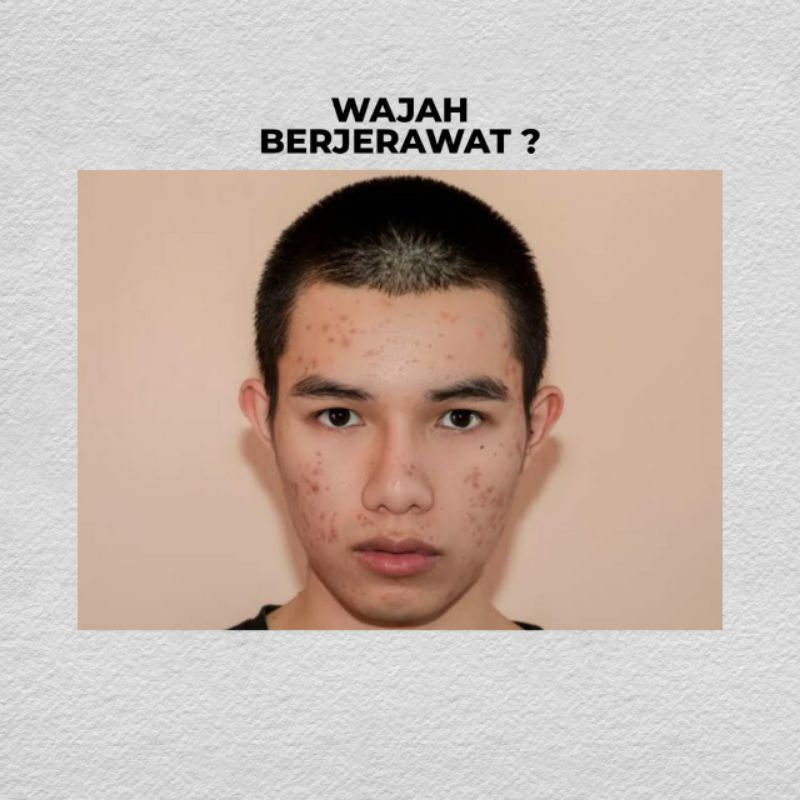CLORISMEN ACNO SERIES CLORIS MEN Paket Acno Perawatan Wajah Berjerawat Skincare Pria Atasi Jerawat Komedo Beruntusan Dan Bopeng Bekas Jerawat Flek Hitam Meregenerasi Kulit Wajah Kembali Mulus Original BPOM-1