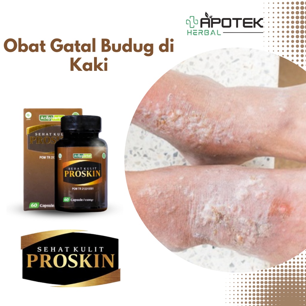 Obat Gatal Budug di Kaki, Obat Gatal Budug Santri, Obat Gatal Koreng, Obat Gatal Borok, Obat Gatal J