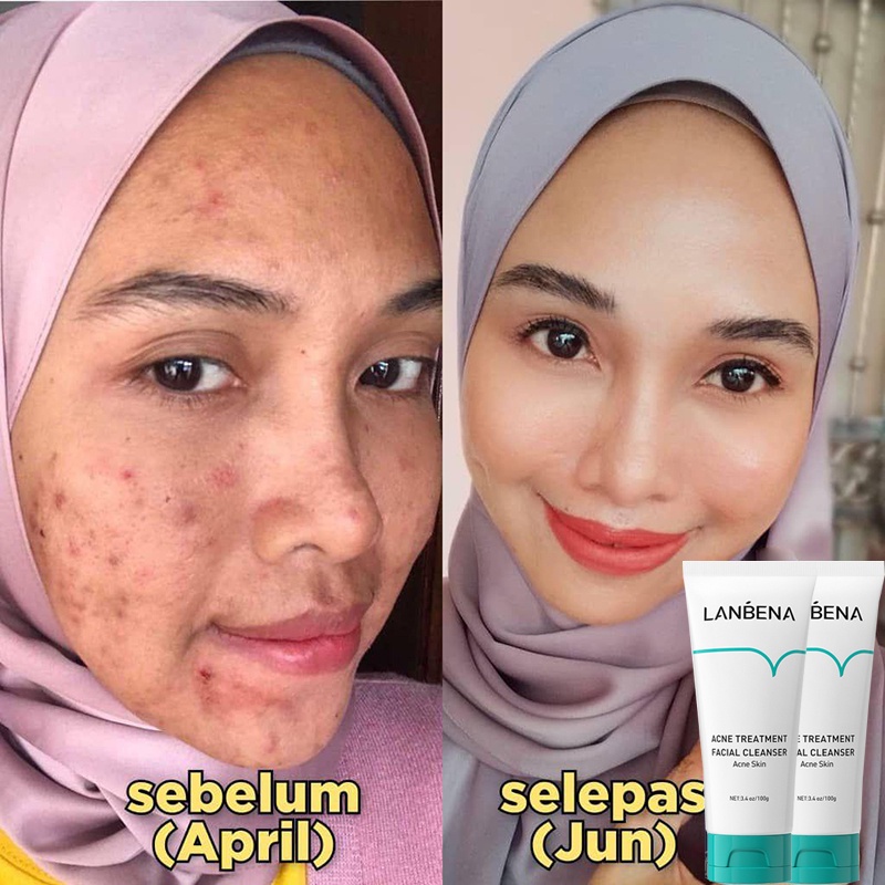 Face Wash Pembersih Wajah Sabun Cuci Muka 100g Pembersih Jerawat Oligopeptide Pembersih Perawatan Jerawat