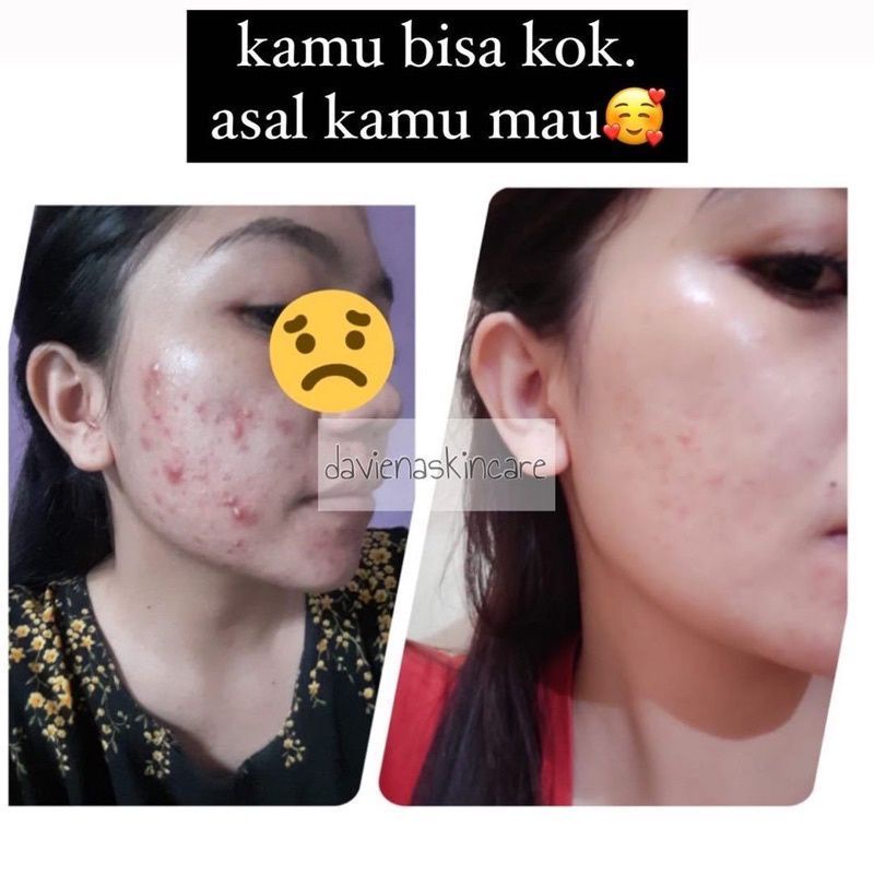 Paket Hemat Acne 2 Daviena Skincare Series Davienaskincareofficial Davina Devina Lampung Surabaya Jakarta Jerawat Pencerah Pemutih Wajah Glowing Bpom Daviena Skincare