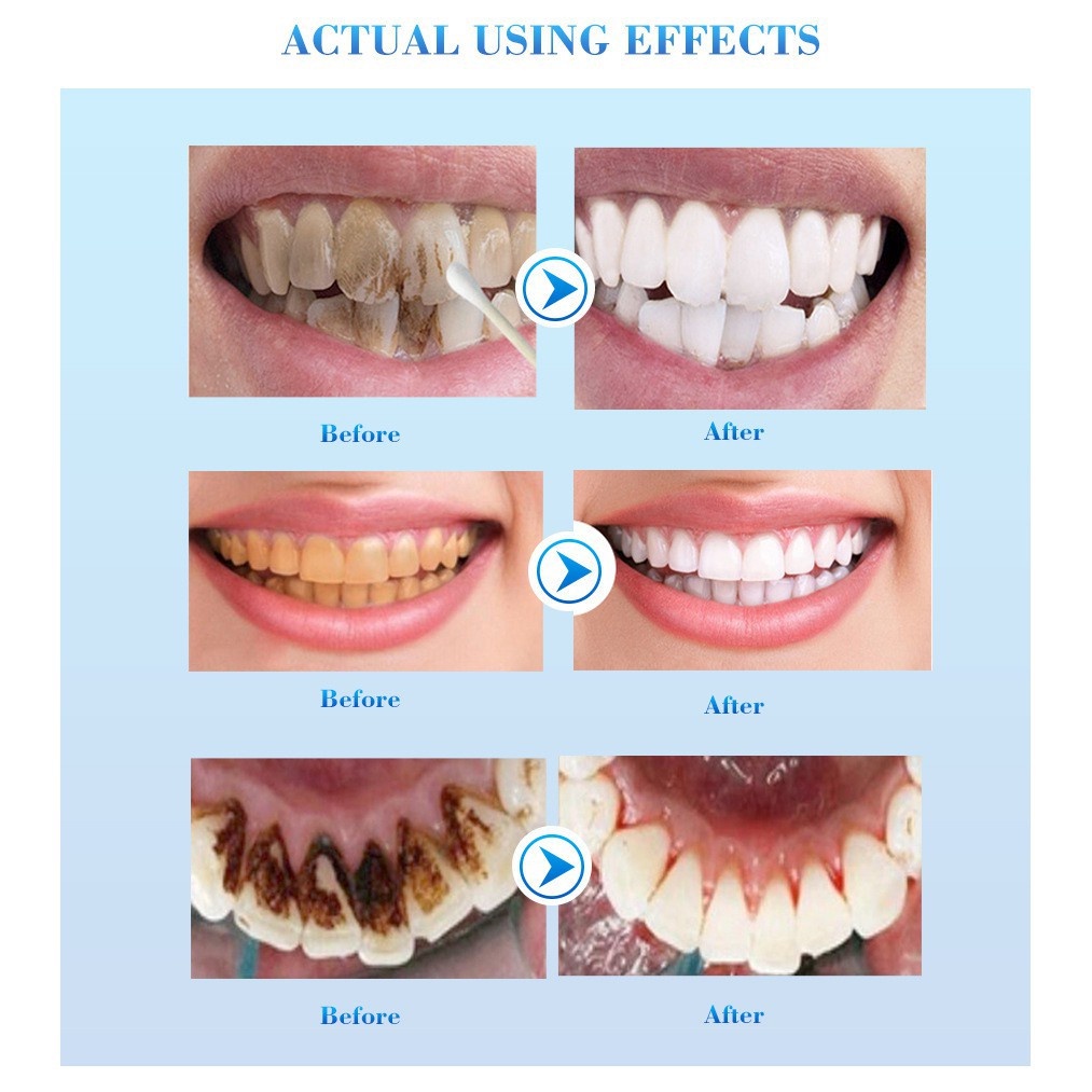 Esensi pemutih gigi Whitening teeth Cairan 10ml Menghapus Noda asap karang gigi kalkulus Kebersihan mulut Esensi pembersih Nada segar