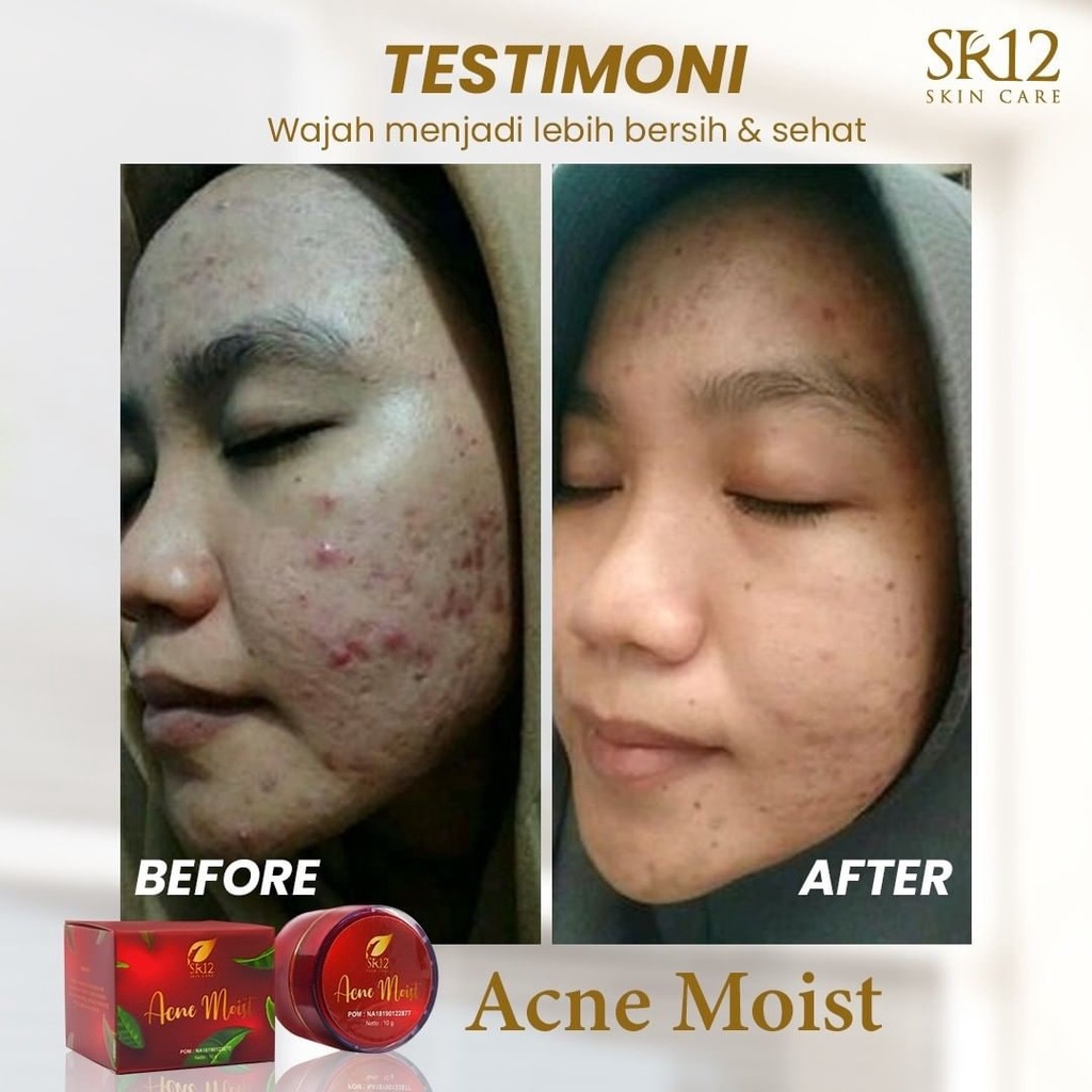 SR12 Krim Kulit Berjerawat Acne Moist Krim Siang SR12 ORIGINAL