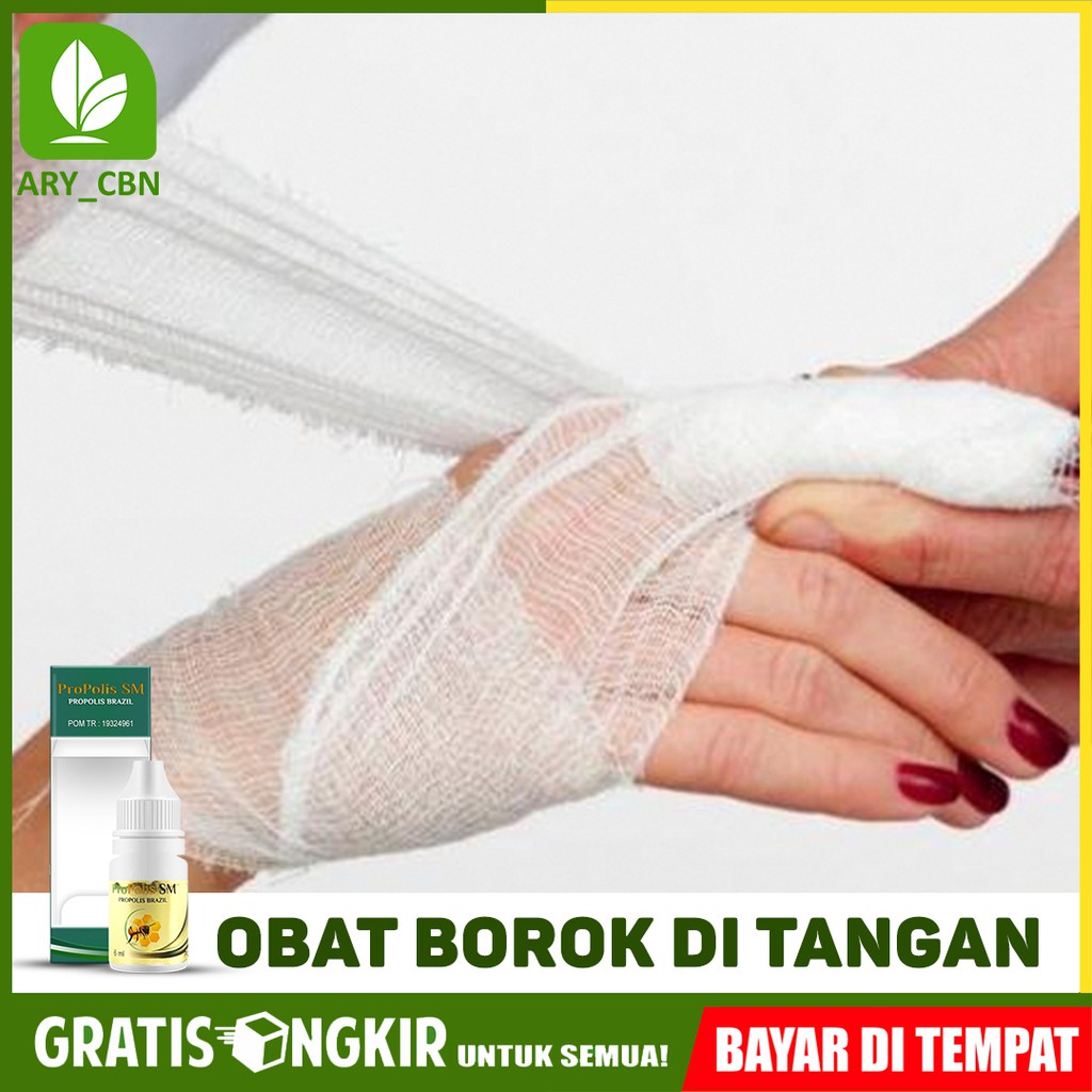 

Obat Borok Di Tangan Kaki Kepala Infeksi Kulit Herbal Propolis SM Brasil Bisa COD Di Cirebon