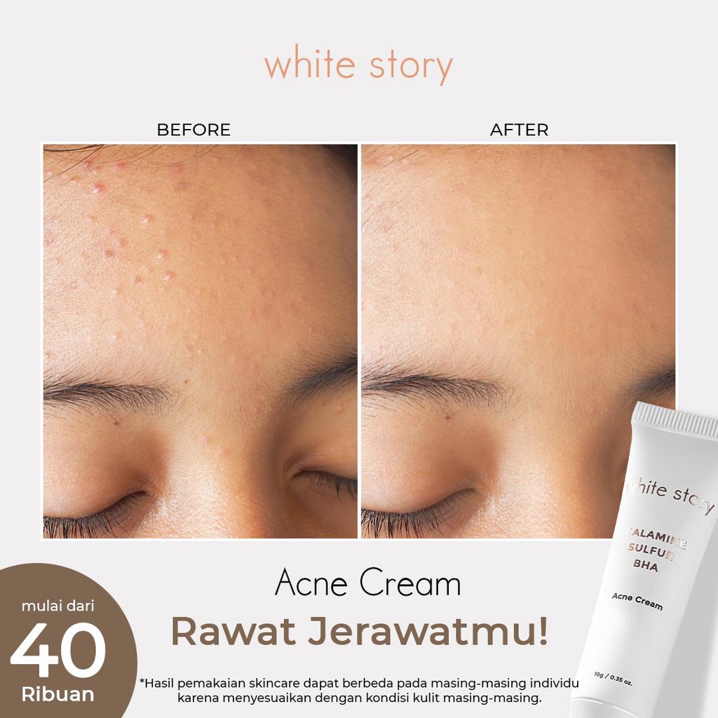 White Story Acne Cream