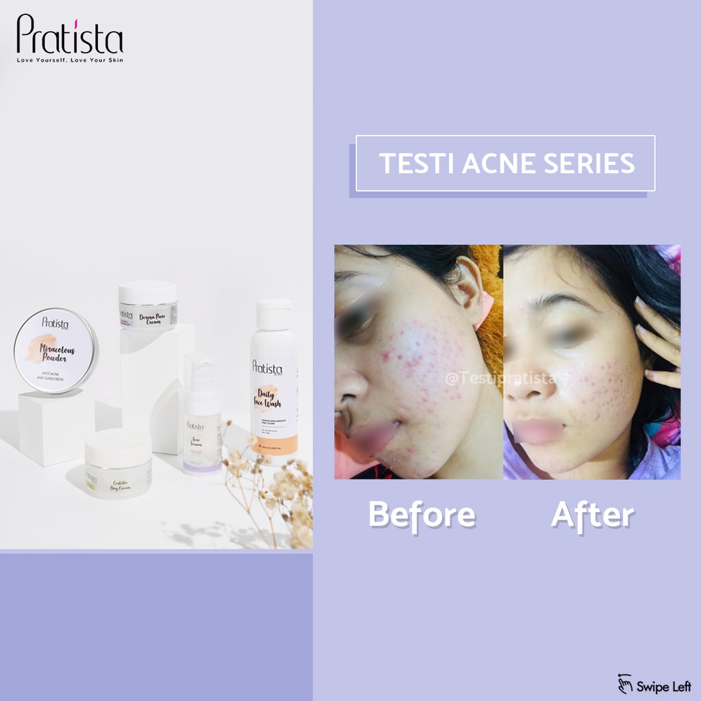 Pratista - Acne Facial Wash