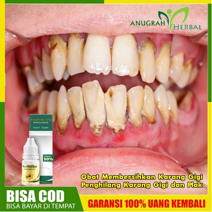 Obat Membersihkan Karang Gigi, Penghilang Karang Gigi dan Plak, Herbal Pembersih Gigi Kuning & Karan