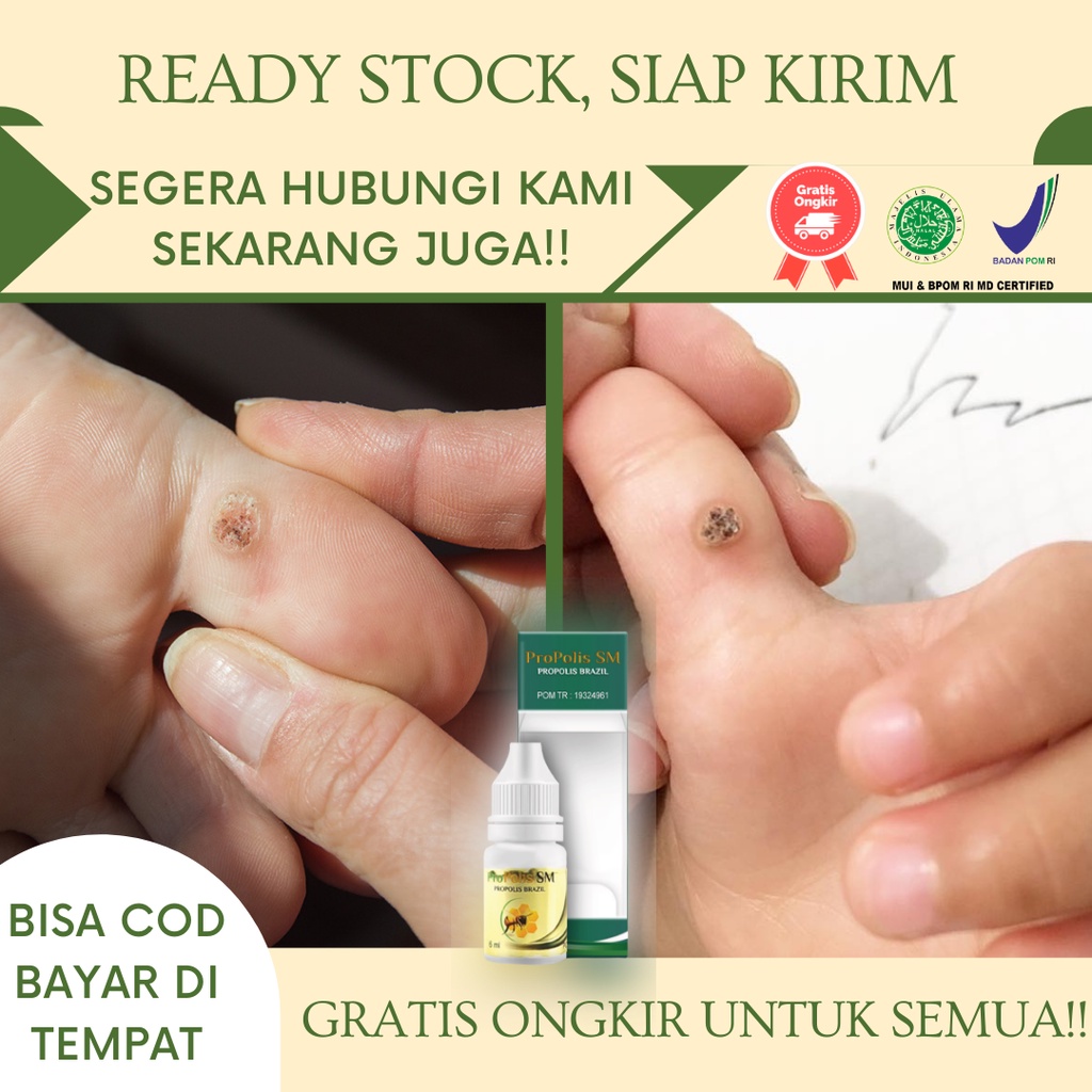 Obat Mata Ikan Telapak Kaki, Obat Mata Ikan diTangan, Obat Mata Ikan diKaki, Obat Mata Ikan di Jari 
