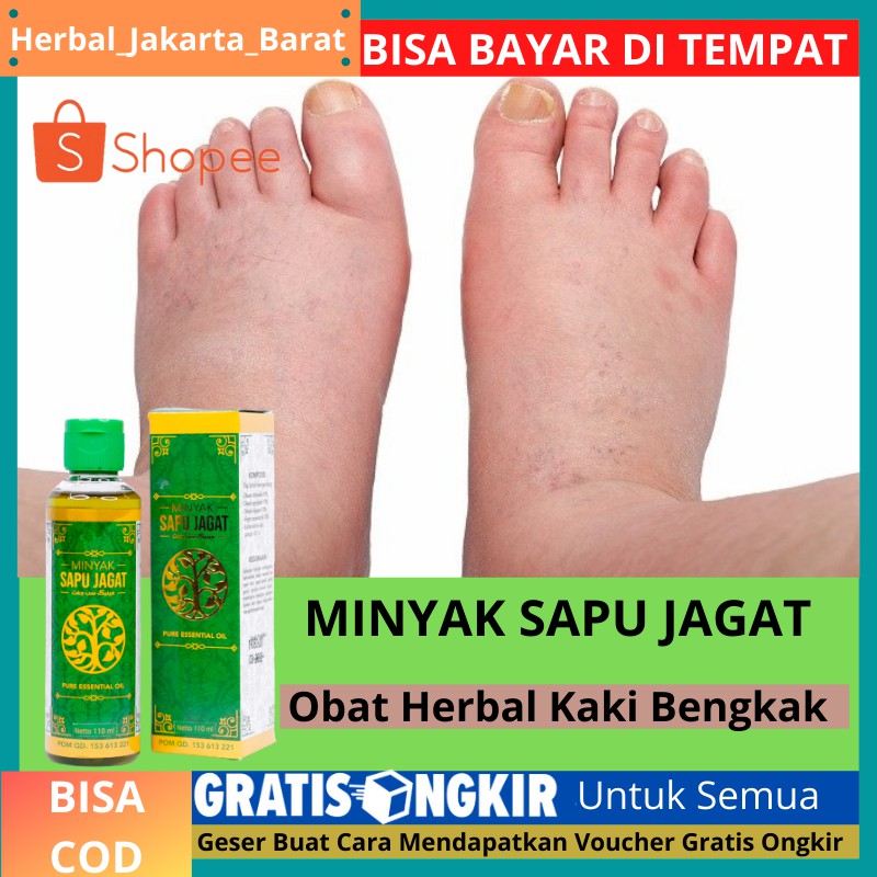 Obat Kaki Tiba Tiba Membengkak Sehabis Jatuh Luka Kaki Bengkak Akibat Keseleo Minyak Sapu Jagat Shopee Indonesia