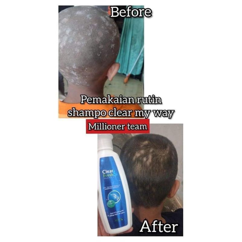 MY WAY shampo clear fresh ampuh banget buat ketombe yang parah sekalipun ko
