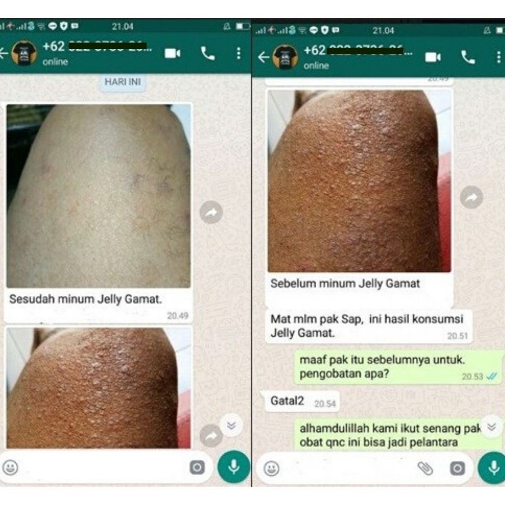 Salep Obat Keratosis Pilaris Penyakit Kulit Jengger Ayam Herbal Qnc Jelly Gamat Bisa Di Oles Shopee Indonesia