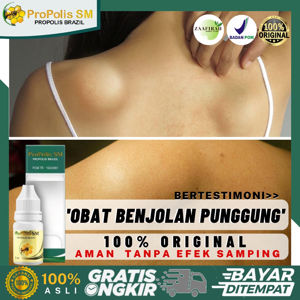 Obat Benjolan Di Punggung Obat Herbal Benjolan Di Pundak Obat Untuk Benjolan Keras Di Punggu Obat Ol