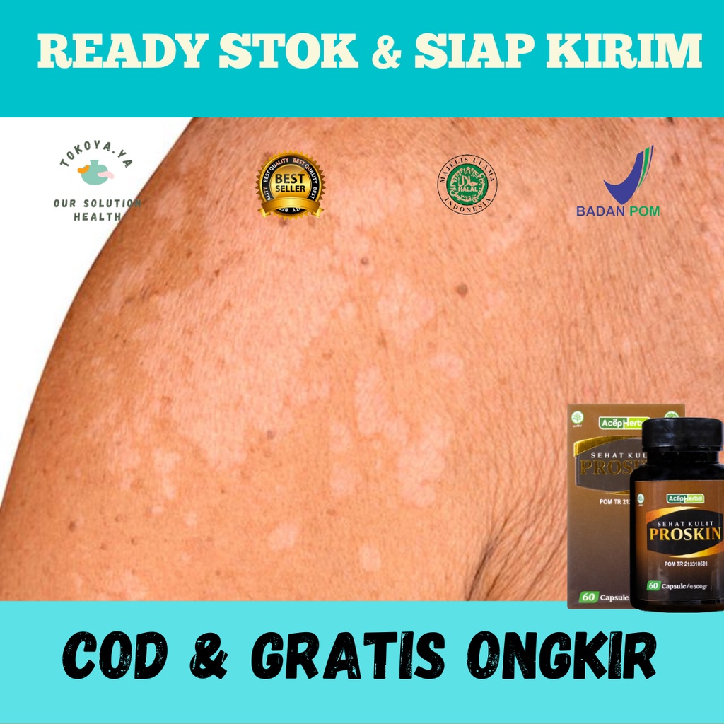 Obat Penghilang Balas Bogo Di Wajah, Obat Menghilangkan Panu, Obat Ngilangin Balas Bogo, Obat Hapur 