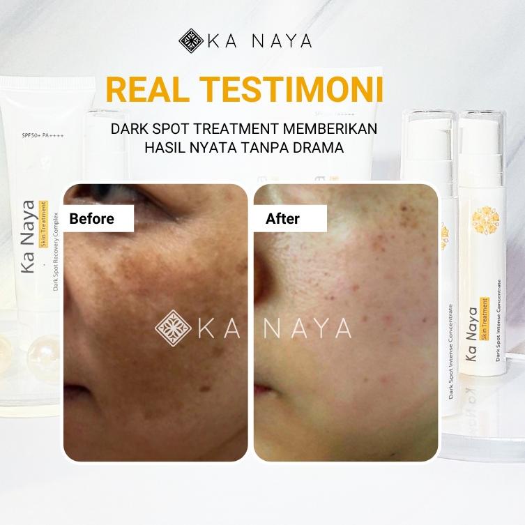 [Art. 0484] Ka Naya Paket Dark Spot | Menghilangkan Flek Hitam | Cream Flek Hitam Membandel | Dark S