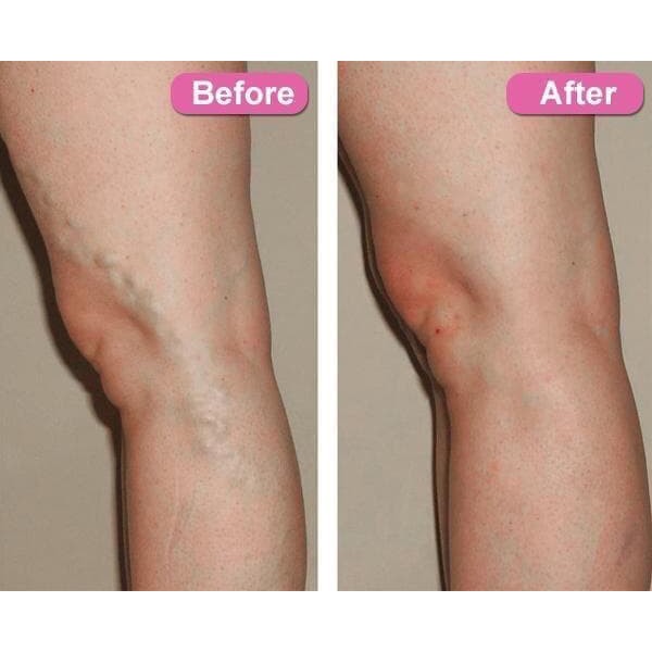 Obat varises Salep penghilang Varises Tanpa Operasi - Varicose Veins Treatment Cream