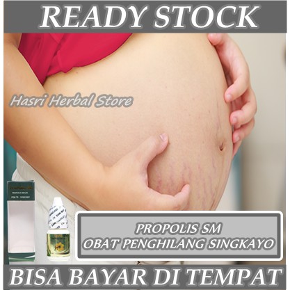 Obat Menghilangkan Singkayo Di Paha Betis Dan Perut, Stretch Mark, Bekas Pasca Melahirkan