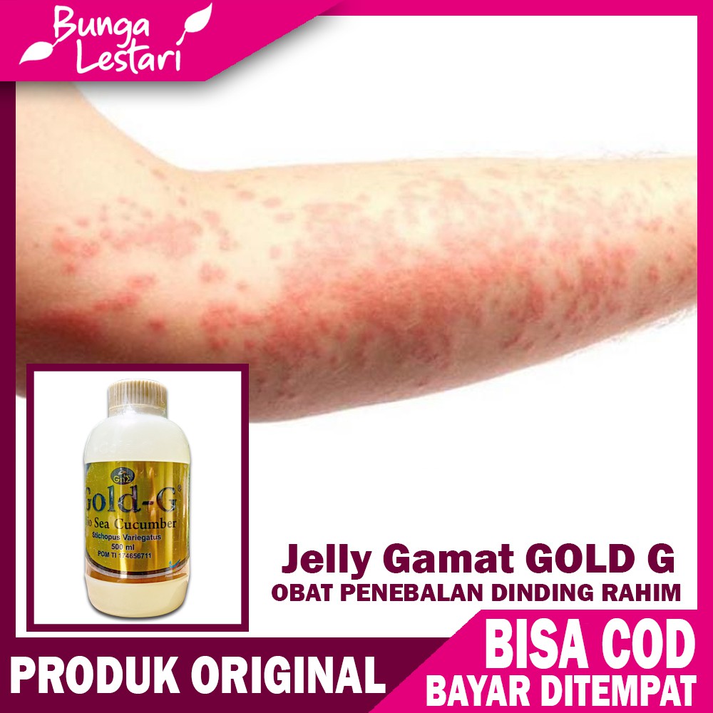 [Manjur] Obat Biduran, Alergi, Kaligata Akut, Gatal-Gatal, Kaligata Menahun, Ruam, Bintik Merah