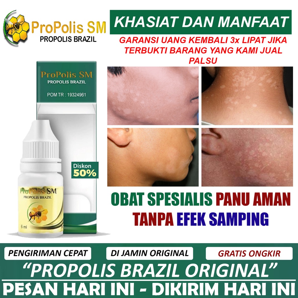 Propolis Sm Asli - Obat Herbal Penghilang Panu Di Wajah - Obat Panu Di Wajah - Panu Di Punggung - Ob