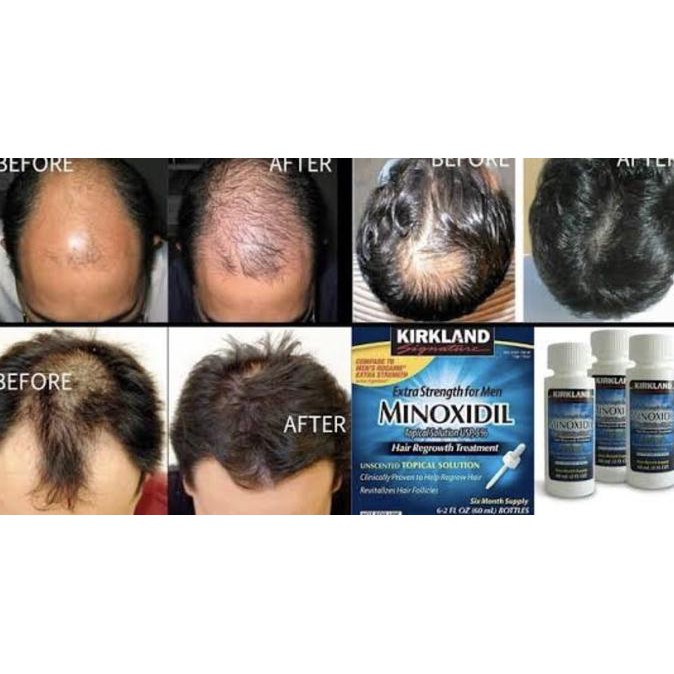 KIRKLAND - MINOXIDIL 5% ( 1 kotak isi 6 botol)