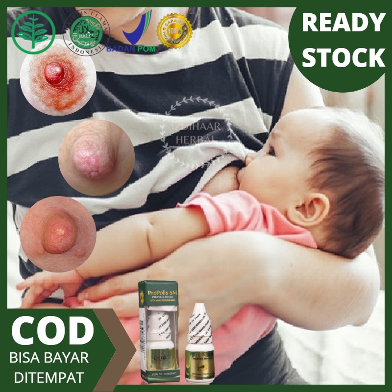 Obat puting lecet menyusui yang aman untuk bayi, Obat puting lecet, Obat herbal puting lecet, Obat l