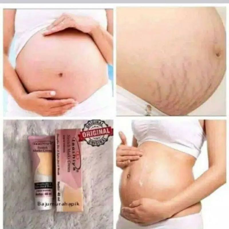 CREAM PENGHILANG STRETCH MARK SELULIT GURATAN KULIT di Perut Kaki Tangan | Laoshiya Cream BPOM