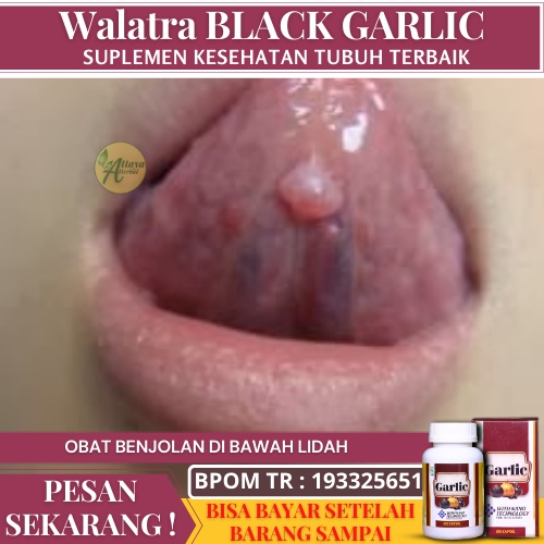 Obat Benjolan Di Bawah Lidah, Benjolan Berwarna Merah Di Lidah, Obat Benjolan Di Mulut, Tumor Lidah,