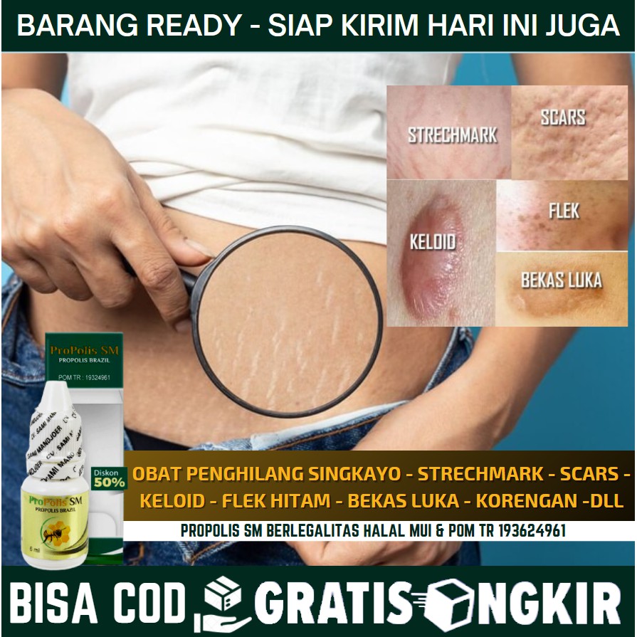 Obat Oles Alami Untuk Menghilangkan Singkayo, Stretch Mark, Garis Putih di Perut, Betis, Pinggang