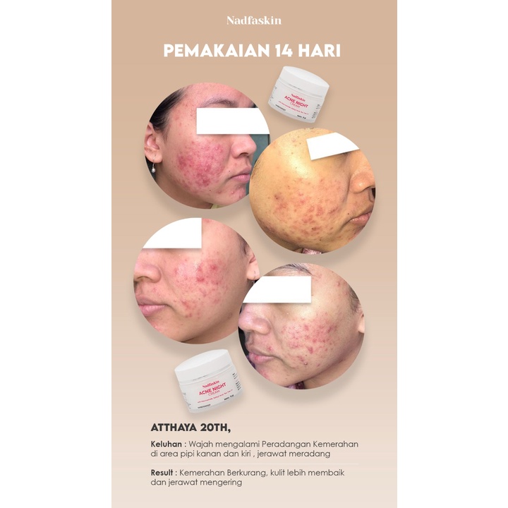 [NEW PACKAGING] Acne Night Cream 15gr &quot;Nadfaskin&quot;