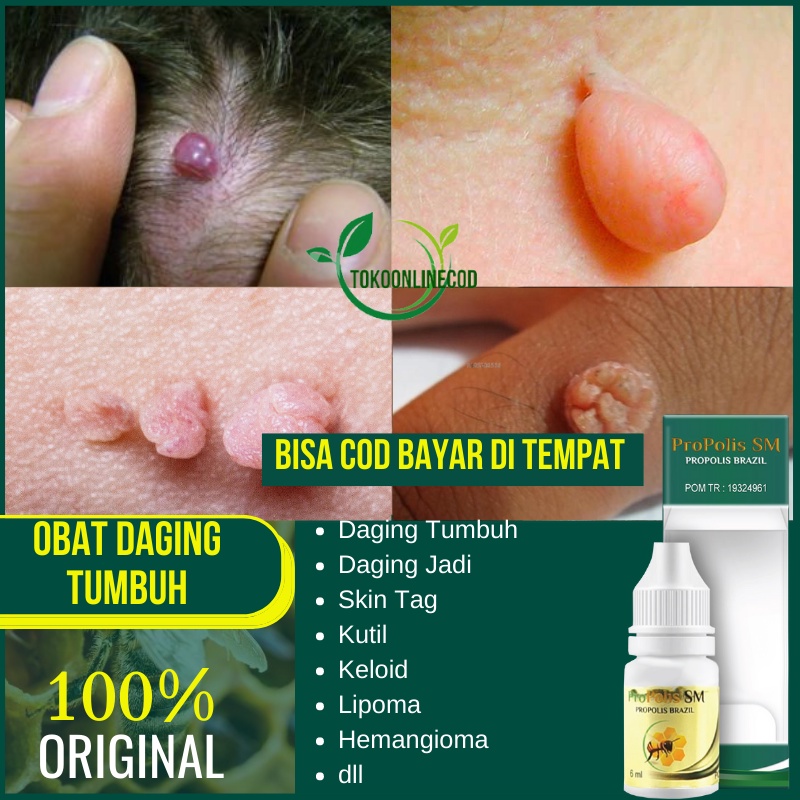 Jual Obat Daging Tumbuh di Kulit Kepala - di Wajah - di Gigi- Bibir