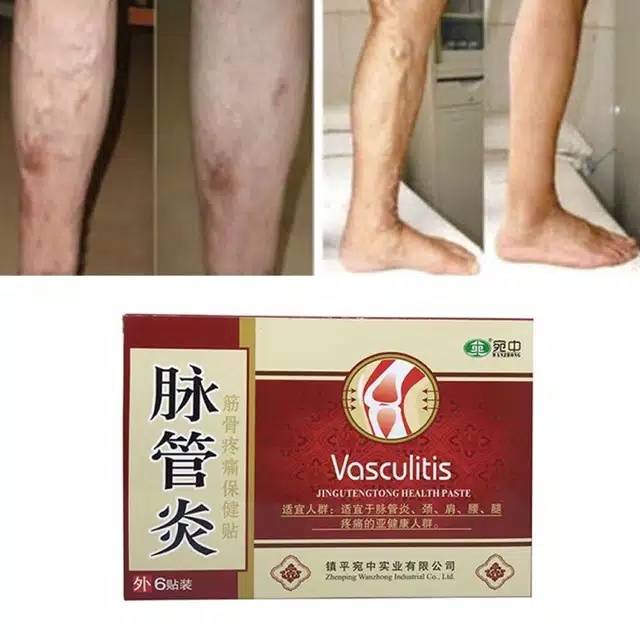 Vasculitis Koyo Herbal Pengobatan Varises