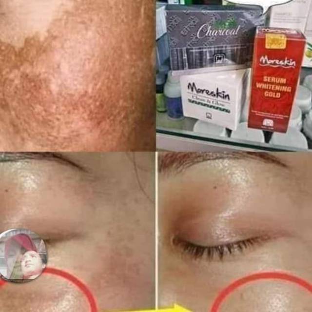 Paket Flek Hitam Nasa