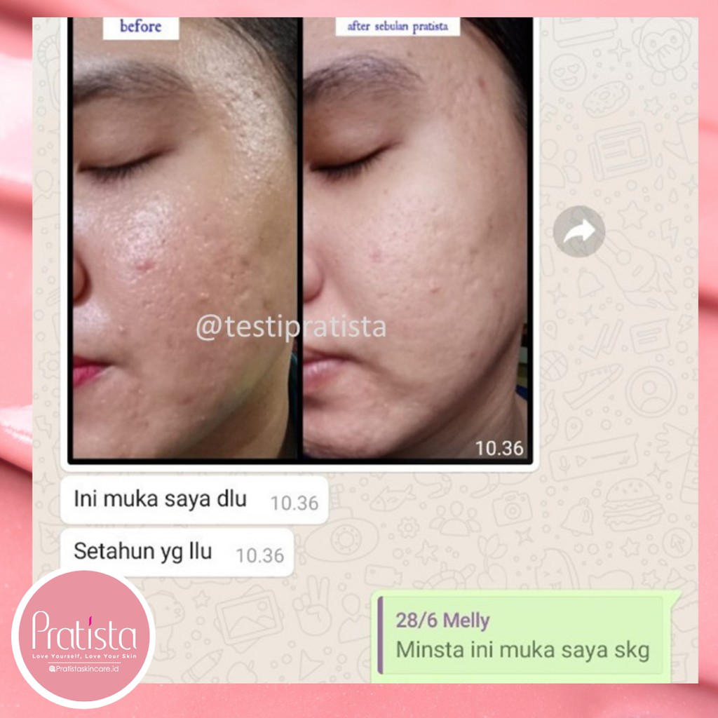 Obat Cream Penghilang Bopeng Pratista Centella Enrich Cream Original Shopee Indonesia