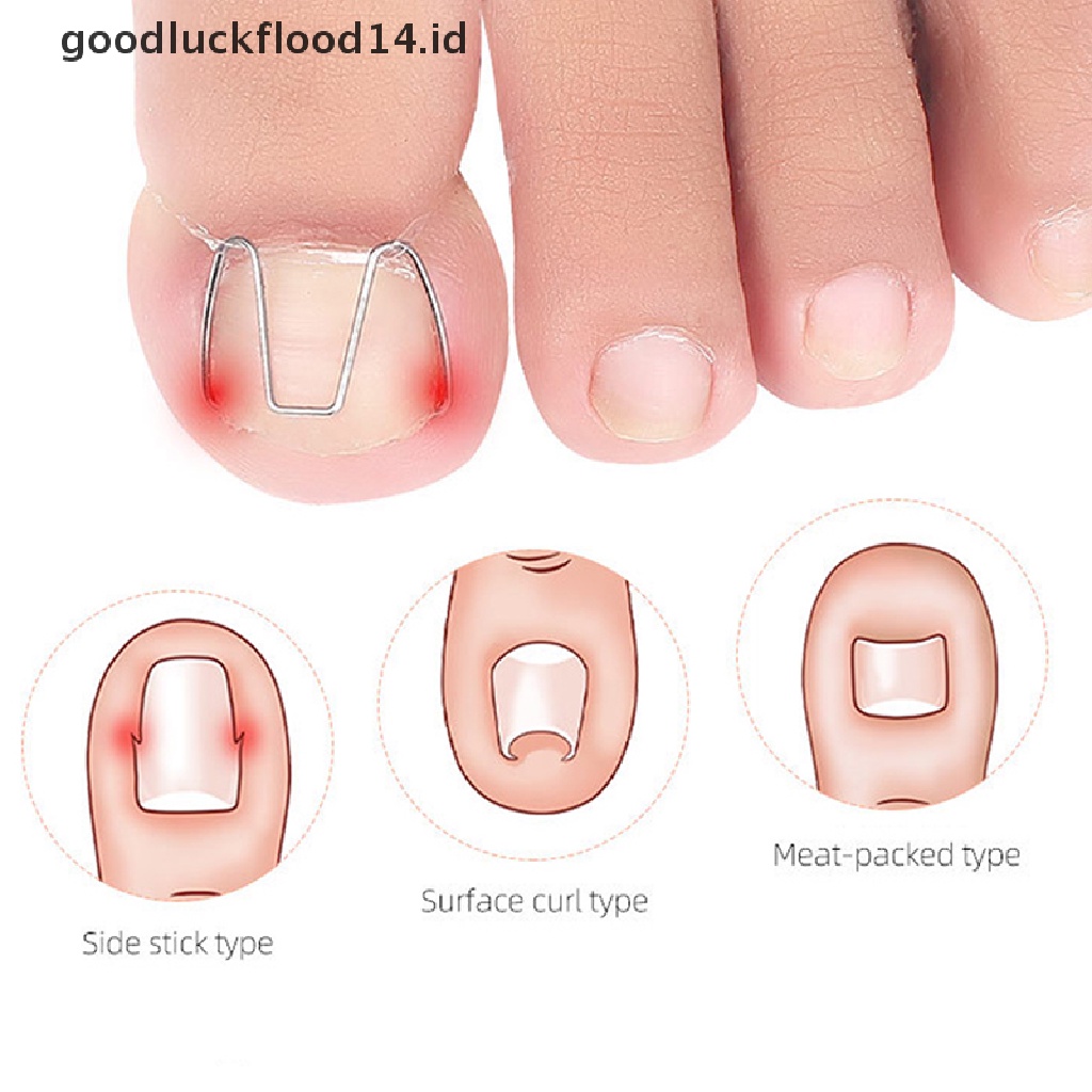 [OOID] Nail Art Ingrown Toe Nail Correction Tool Toenail Nail Orthosis Paronychia Clip ID