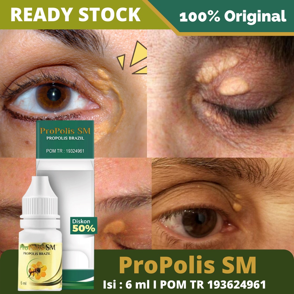 Obat Penghilang Xanthelasma - Obat Oles Mata Xanthelasma, Obat Penghilang Lemak Kuning Di Ujung Mata, Obat Xanthelasma Di Apotik, Obat Gumpalan Lemak di Kelopak Mata, Obat Rekomendasi Penyakit Xanthelasma, Salep Kuning Di Sudut Mata Dengan Propolis SM