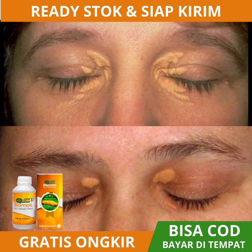 Obat Xanthelasma, Obat Penghilang Xanthelasma, Obat Menghilangkan Xanthelasma, Gumpalan Lemak Di Kel