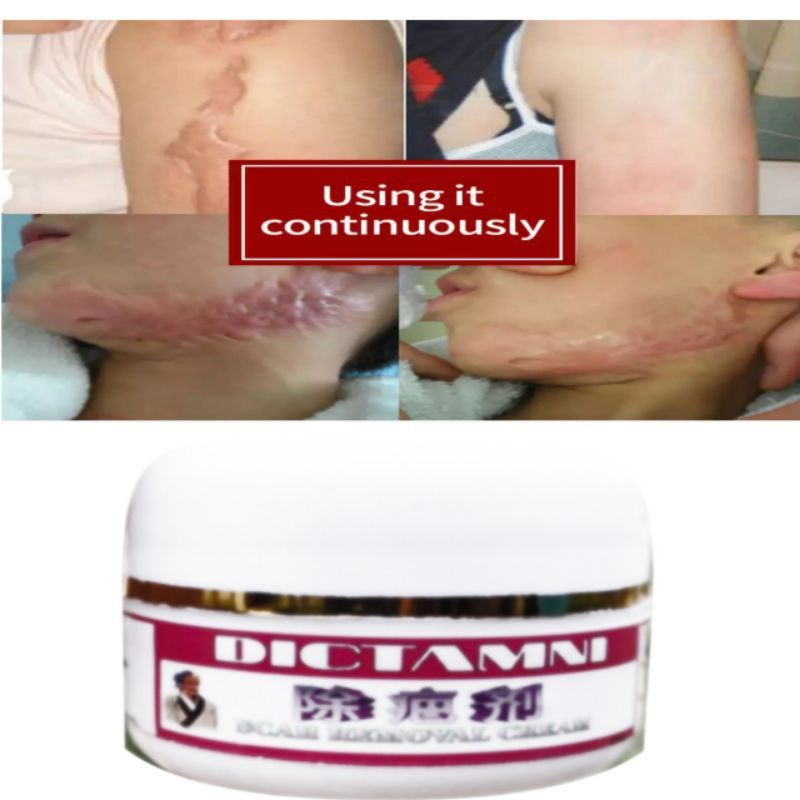 CREAM DICTAMNI PENGHILANG BEKAS LUKA DAN KELOID