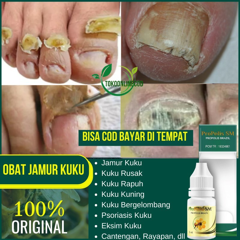 Obat Jamur Kuku, Penghilang Jamur Kuku Kaki, Salep Kuku Jamur dan Rusak, Cairan Pembersih Kuku - COD