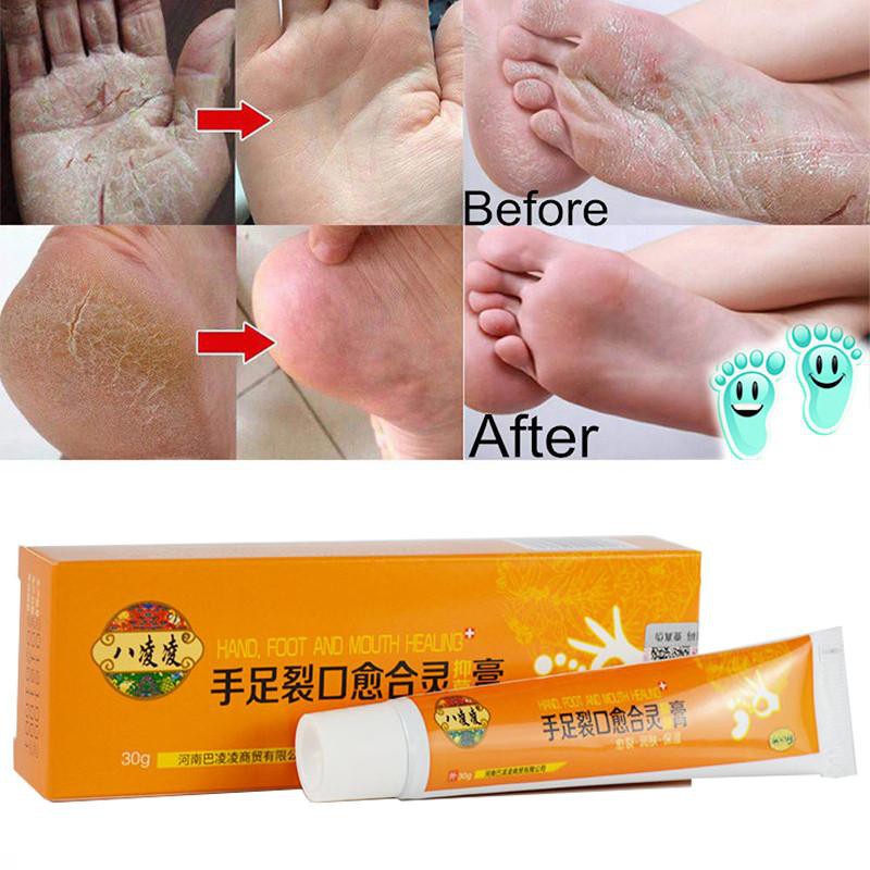 [100% Asli + COD] Obat Kaki Tangan Kapalan Pecah - Pecah Krim Tumit Pecah-pecah Mengupas Kaki