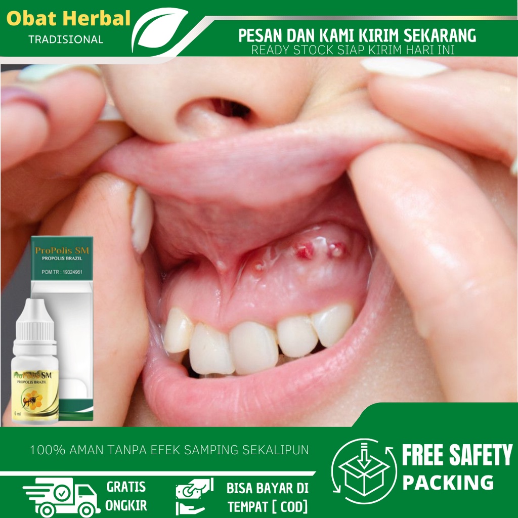 Obat Abses Gigi, Abses Gusi, Benjolan di Gusi, Obat Abses Bernanah,  Obat Gusi Bengkak Dan Nyeri, Ra