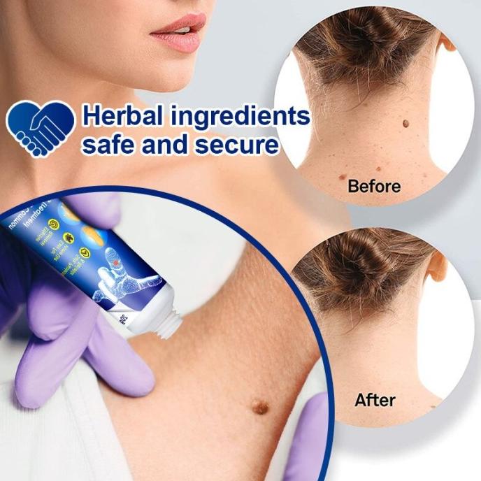 Skin Tag Remover SUMIFUN Wart Remover Ointment - Penghilang Tahilalat