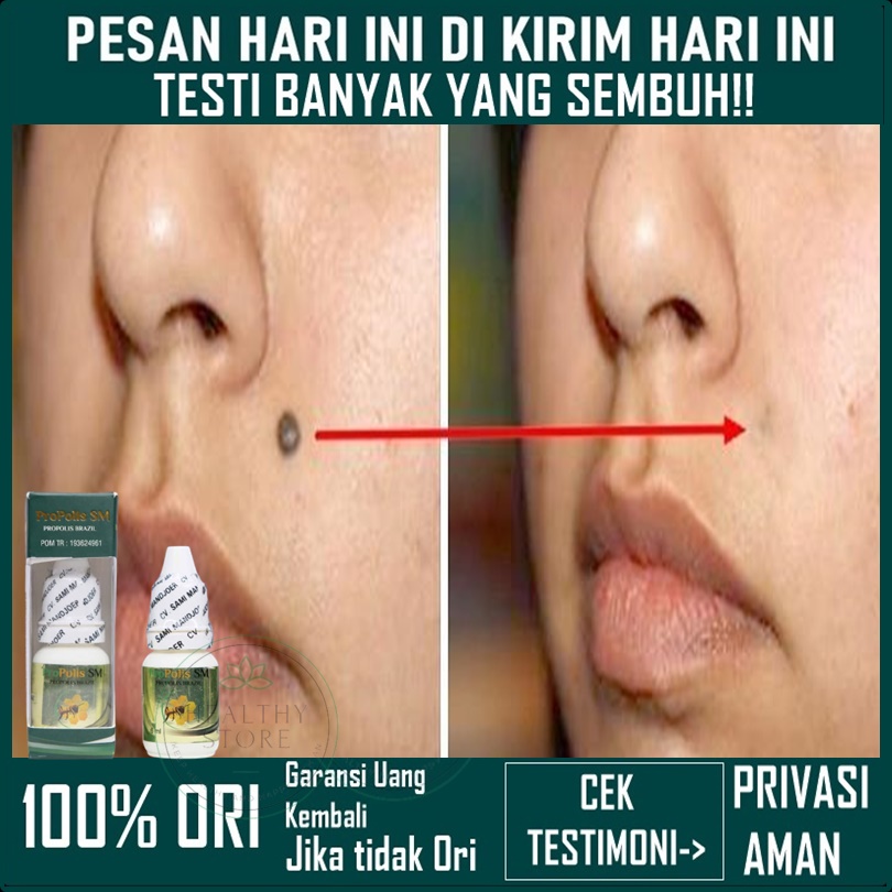 Obat Penghilang Tahi lalat - Penghilang tahi lalat di wajah - Obat Kutil Wajah - Obat Penghilang Kut