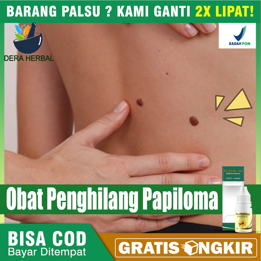 Obat Papiloma, Penghilang Papiloma, Papiloma di Leher dan Wajah, Kutil di Kelamin Herbal Propolis Sm