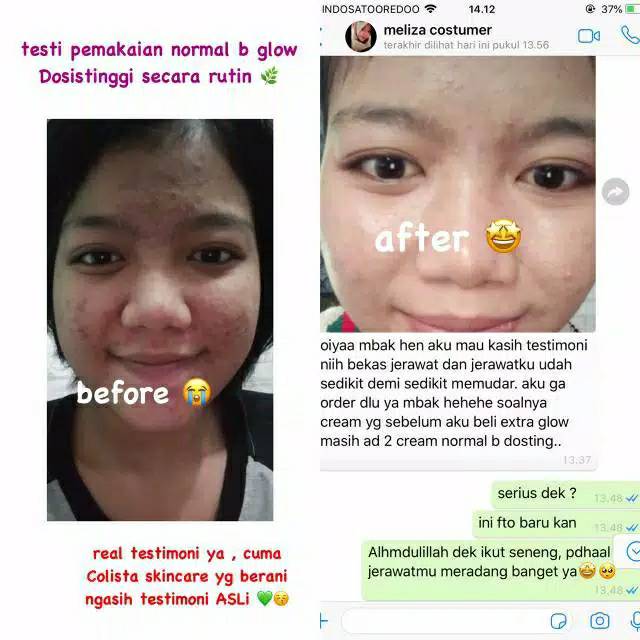 Reaksi Awal Pemakaian Theraskin Acne Glow Easy Study