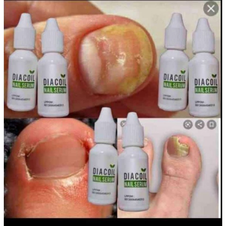 DIACOIL | PENGHILANG BEKAS LUKA | PENGHILANG JAMUR KUKU