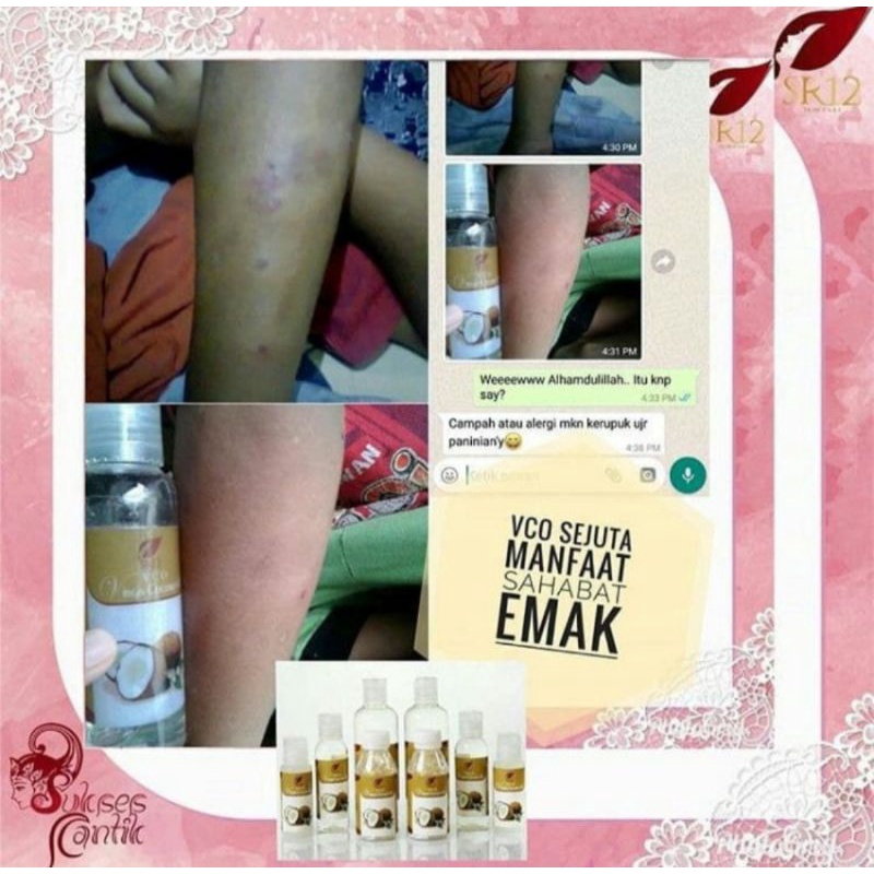 VCO SR12 MINYAK KELAPA UNTUK OBAT RUAM POPOK BAYI / Obat Biang Keringat / VCO VIRGIN COCONUT OIL / MINYAK KELAPA MURNI / VICO OIL SR12 / PENAMBAH IMUN TUBUH / SIAP NEW NORMAL