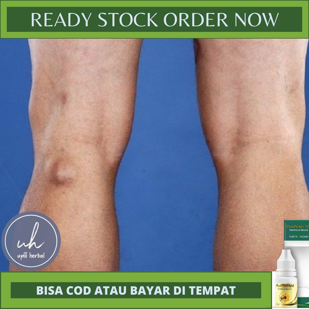 Obat Kista Baker (Baker's cyst), Obat Kista Popliteal, Obat Alami Hilangkan Kista Baker, Obat Penghi