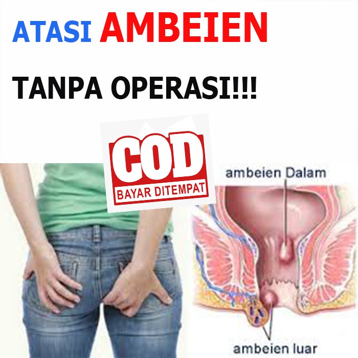 Obat Wasir Ambeien Stadium 1 Sampai 4 Paling Ampuh Herbal Shopee Indonesia