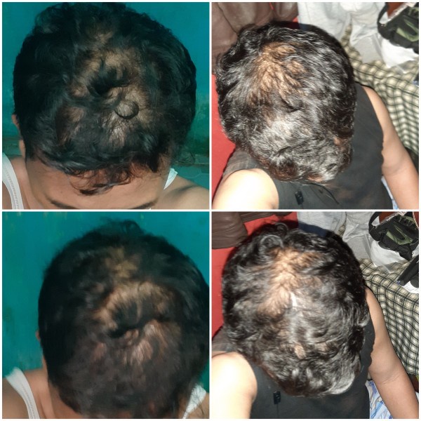 Happy Green Custom Oil buat Kesehatan Rambut Faktor Keturunan - Genetic Hair Loss