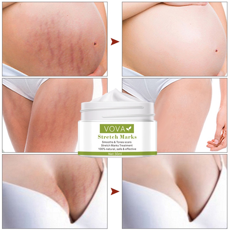 Krim Kehamilan StretchMark 30ml Cream krim bekas luka Pengencang Kulit Solusi Perut Gatal dan Anti Stretchmark Ibu Hamil StretchMark Krim Penghilang Stretch Mark mama choice stretch mark