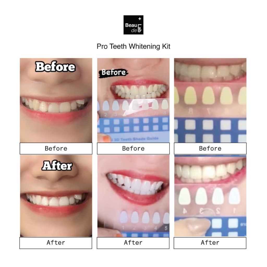 PRO TEETH WHITENING KIT Alat Pemutih Gigi Permanen |  Beaudelab Memutihkan Gigi Super Cepat NewLab New Lab